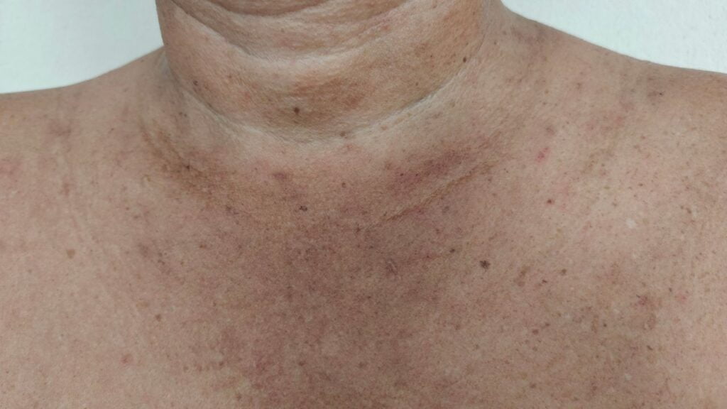 Manchas Escuras na Pele: O Que Pode Ser e Como Tratar Manchas escuras na pele